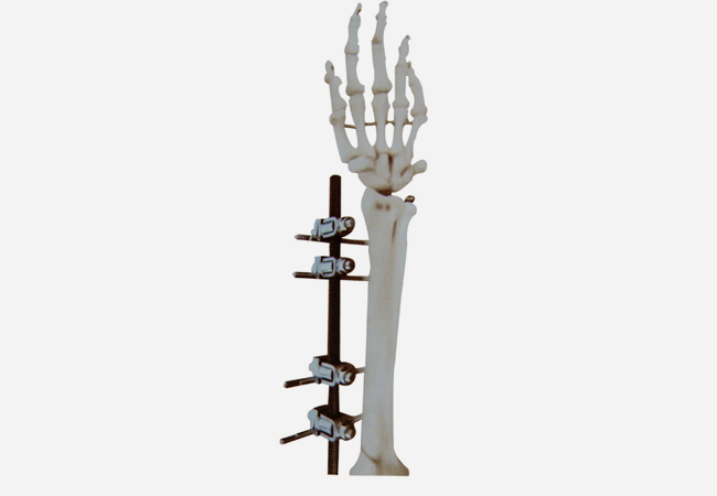 Ⅲ型支架 尺桡骨、肱骨骨折