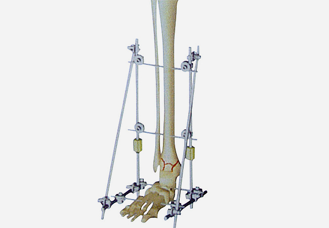  Ⅳ型1号 踝关节骨折
