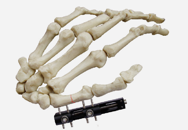 指掌骨骨折D型