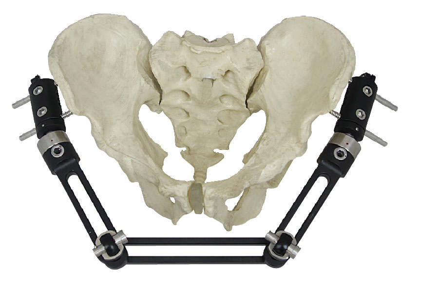 骨盆骨折A型