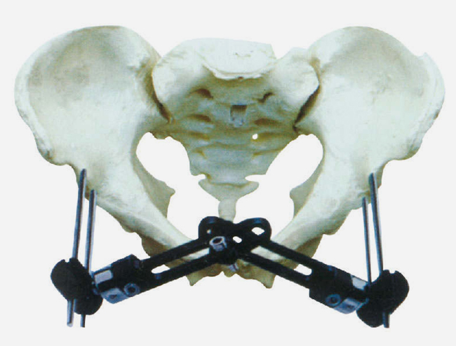 骨盆骨折B型