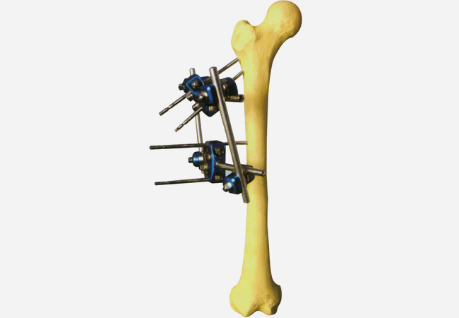 Ⅳ型2号 股骨近端支架